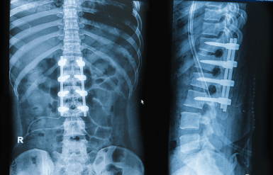Upper Lumbar Fusion XRay