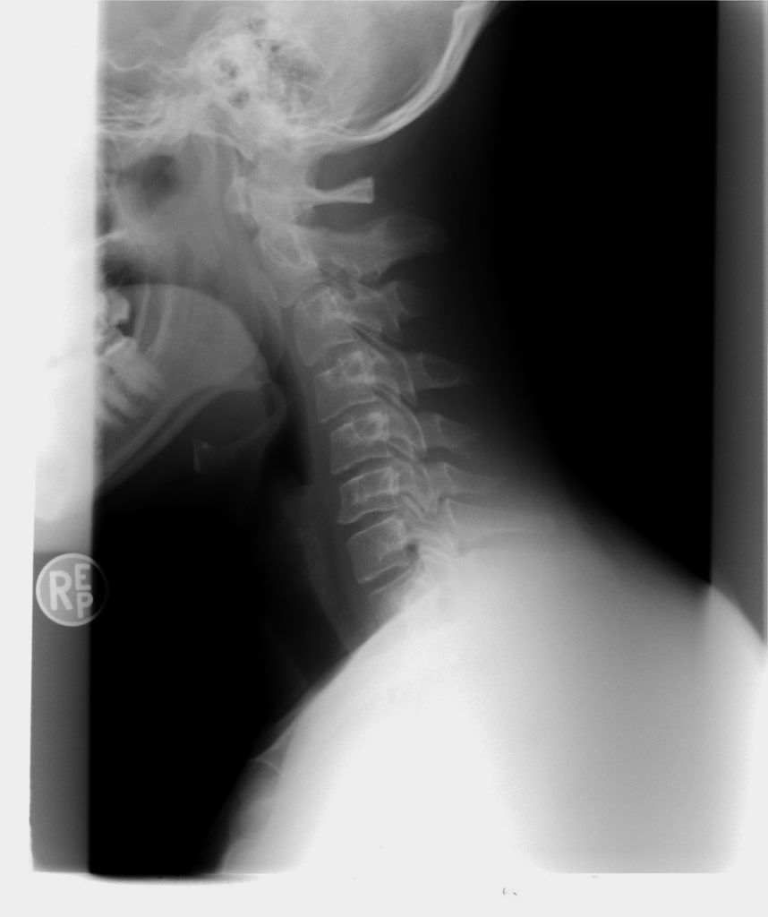 cervical spine xray, reverse curve